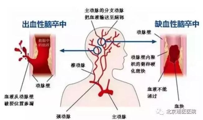 中国人脑卒中发病率世界第一，且有年轻化趋势(图3)