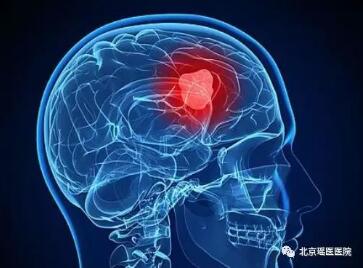 【脑瘤科普】鼻子“有毛病” ，警惕脑肿瘤(图2)