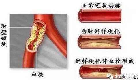 再不看就晚了，秋季是心脑血管疾病的高发期!(图2)