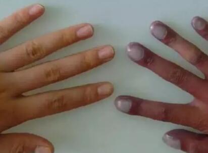 体内有肿瘤，手脚先知!医生提醒：手脚出现8种变化，不要拖(图3)