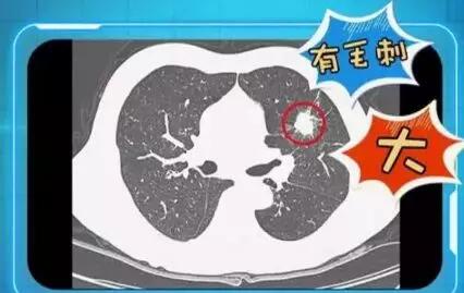 体检后发现“肺部有阴影”一定是得了肺肿瘤?哪些生活习惯(图3)