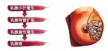 乳腺增生久了会发展成乳腺肿瘤吗?其实它没那么恐怖!(图2)