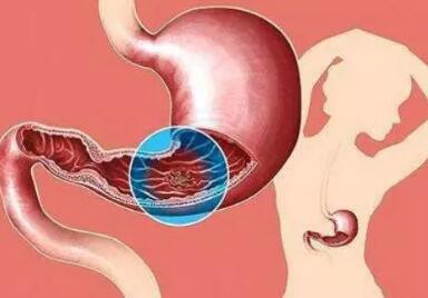 常打嗝是胃肿瘤前兆?这样打嗝小心胃肿瘤作祟(图3)