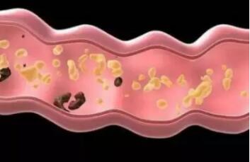 “屁事”不重视,27岁白领每天放屁数十次,医生告知:肠肿瘤晚(图3)