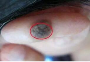不起眼的“小疙瘩”竟是皮肤肿瘤！(图3)