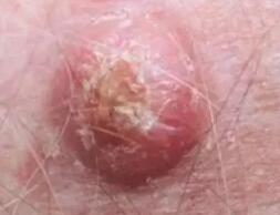 不起眼的“小疙瘩”竟是皮肤肿瘤！(图2)