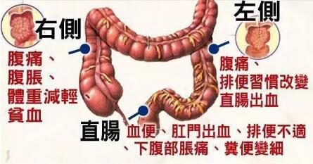 大便变细就是得了肠肿瘤?医生说：不一定，还有这些可能(图3)