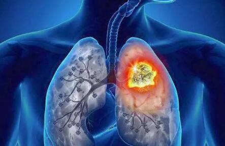 肿瘤来之前，都会有“瘤前病变”!很多人没重视(图3)