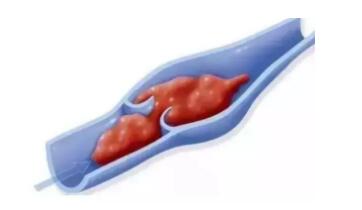 肿瘤晚期患者为何会出现下肢水肿?如何应对?(图2)