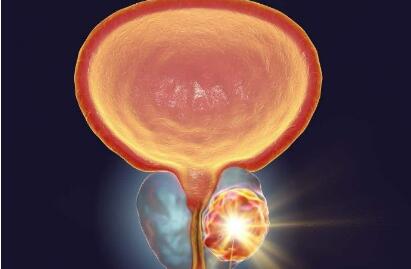 前列腺肿瘤的3个早期症状，50岁以上的男性要当心(图3)
