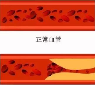 血栓容易“投靠”五种人，想甩都甩不掉，牢记这“三字诀(图2)