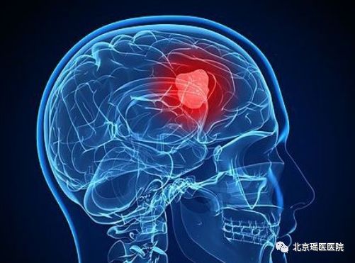 鼻子“有毛病” ，警惕脑肿瘤(图3)