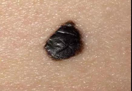 什么样的痣要处理?5种痣一出事就是癌，留不得(图3)