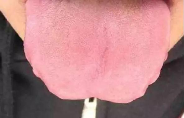 舌苔这些个变化，或是在向你传递“疾病信号”，赶紧自查(图7)