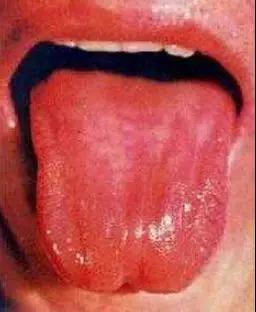 舌苔这些个变化，或是在向你传递“疾病信号”，赶紧自查(图8)