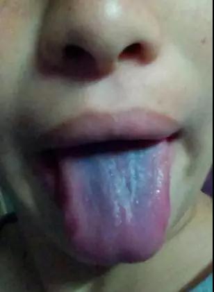 舌苔这些个变化，或是在向你传递“疾病信号”，赶紧自查(图4)