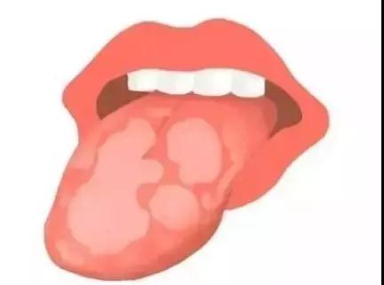 舌苔这些个变化，或是在向你传递“疾病信号”，赶紧自查(图5)