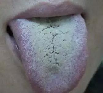 舌苔这些个变化，或是在向你传递“疾病信号”，赶紧自查(图2)