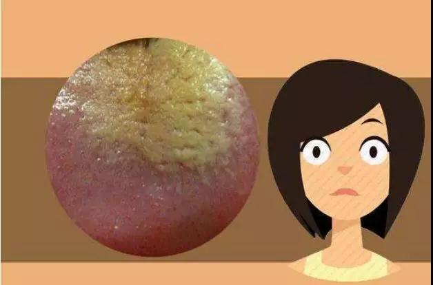 舌苔这些个变化，或是在向你传递“疾病信号”，赶紧自查(图3)