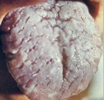 舌苔这些个变化，或是在向你传递“疾病信号”，赶紧自查(图6)