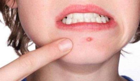 戴口罩起雾、起痘？缓解口罩脸，一篇全搞定！(图3)