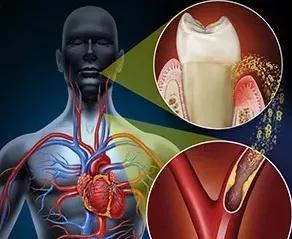 【刷牙可防癌】牙病让食管癌和胃癌发病率上升四五成(图2)
