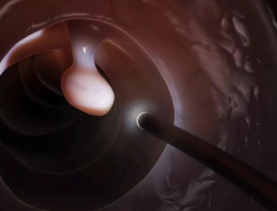 【刷牙可防癌】牙病让食管癌和胃癌发病率上升四五成(图3)