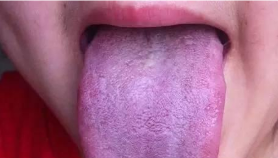 舌头颜色越深，血瘀越严重，如何改善血瘀体质?4大调理方法(图3)