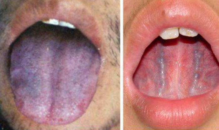 舌头颜色越深，血瘀越严重，如何改善血瘀体质?4大调理方法(图4)