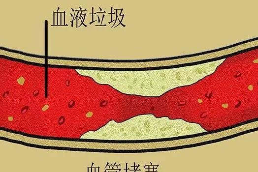 夏天血管开始狭窄，注意睡觉时抽筋是重要信号(图3)