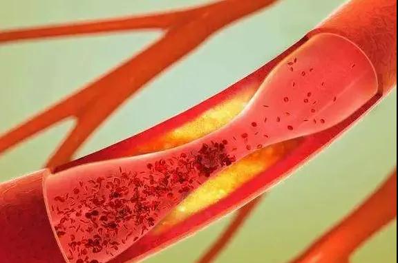 夏天血管开始狭窄，注意睡觉时抽筋是重要信号(图2)