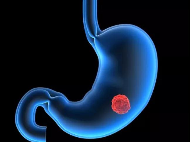 胃溃疡离胃癌到底有多远?(图2)