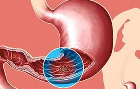 “胃溃疡”到胃癌需要多久？(图2)