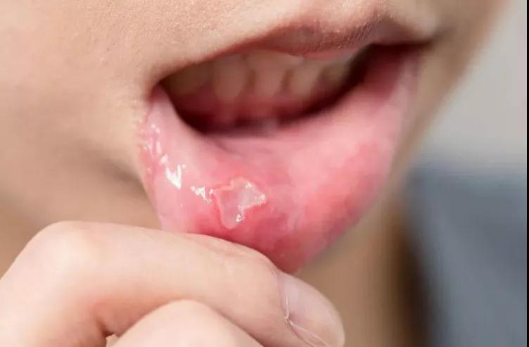 这种口腔“溃疡”小心癌变！别小病拖成大病(图2)