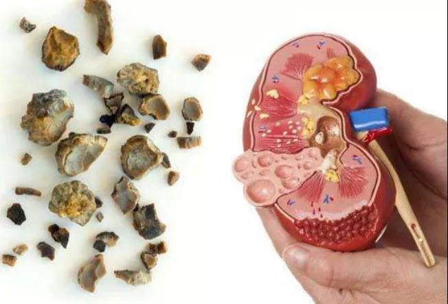 肾结石可诱发肾癌，可惜很多人不知道!(图3)