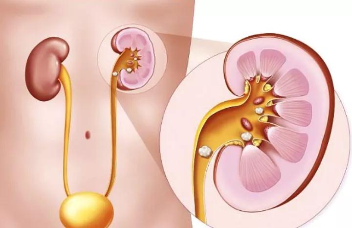 肾结石可诱发肾癌，可惜很多人不知道!(图2)