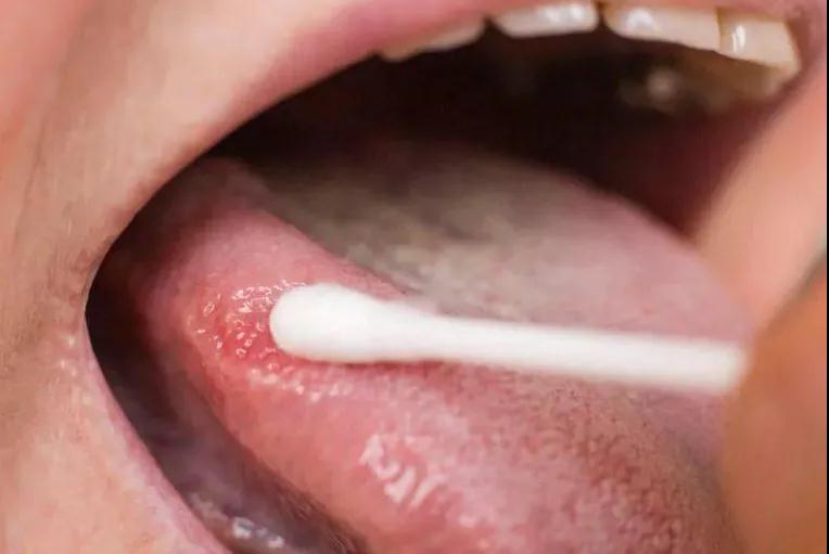 这种口腔“溃疡”小心癌变！别小病拖成大病(图3)