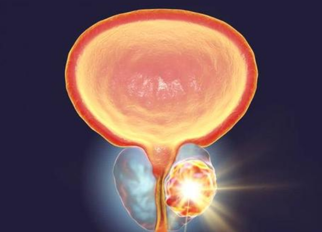 快转给身边的男性!这种癌症，他必须了解!(图4)