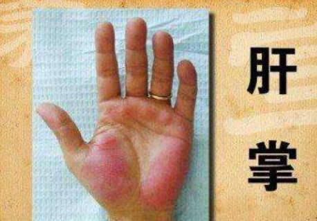 嗜酒的人身体出现这4个信号，酒精肝已“恶化”成“肝硬化(图4)