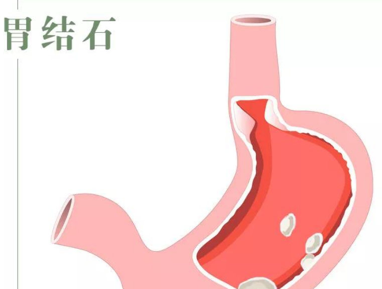 胆结石、肾结石、胃结石……身体里哪来这么多“石头”?(图4)