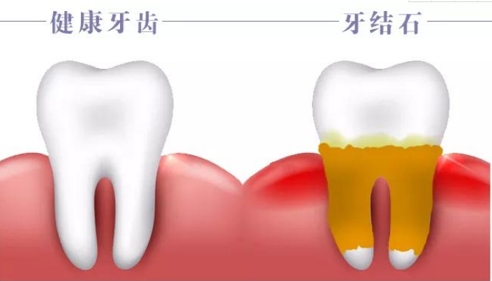 胆结石、肾结石、胃结石……身体里哪来这么多“石头”?(图5)