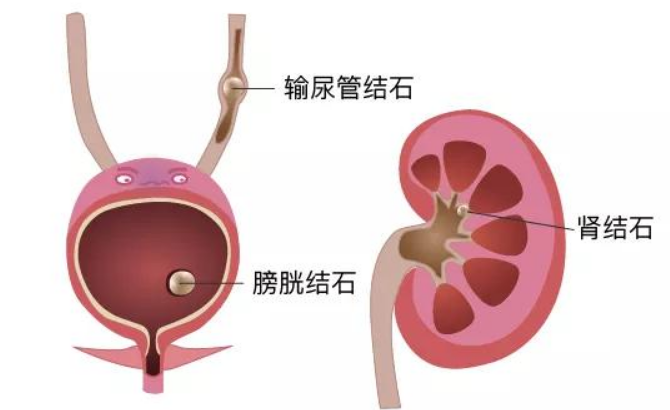 胆结石、肾结石、胃结石……身体里哪来这么多“石头”?(图3)