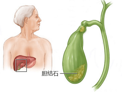 胆结石、肾结石、胃结石……身体里哪来这么多“石头”?(图2)