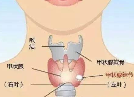 甲状腺结节恶变率达5%—15%，这五类最易“癌变”(图2)