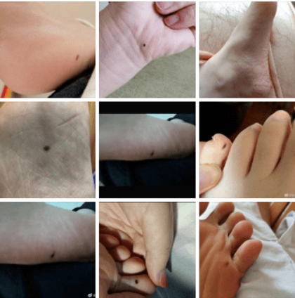 医生提醒：“痣”长这些地方都要切除！(图2)