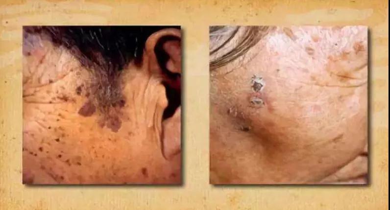 老年斑也有癌变的风险!做好4事远离老年斑(图3)