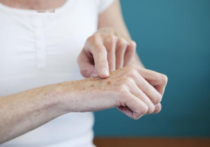 老年斑也有癌变的风险!做好4事远离老年斑(图2)