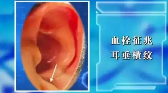 93岁院士说：这样做降脂溶栓护血管，可以少往可以少往医院(图5)