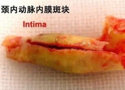 身体有根血管连通大脑，最容易堵，别等瘫痪才知道!(图4)