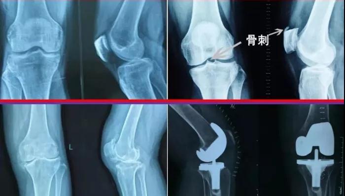 什么“骨刺”竟然是“好”东西?我们一直都“错怪”它了?(图3)